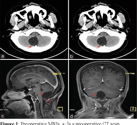 Figure 1 From Intracranial Dermoid Cyst In The Posterior Fossa A Case