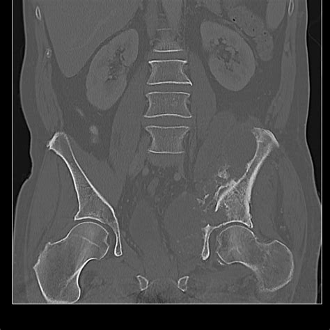 High Grade Chondrosarcoma Of The Pelvis Image