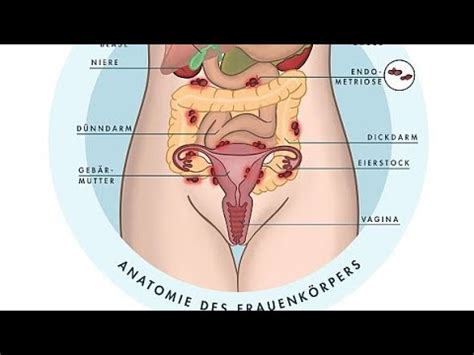 Endometriose das Chamäleon der Gynäkologie YouTube