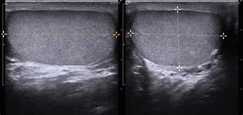 Normal Epididymis Ultrasound