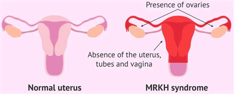 MRKH Syndrome Causes Symptoms Diagnosis Treatment