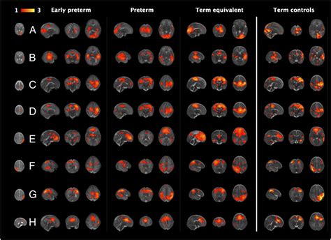 Emergence Of Resting State Networks In The Preterm Human Brain Pnas