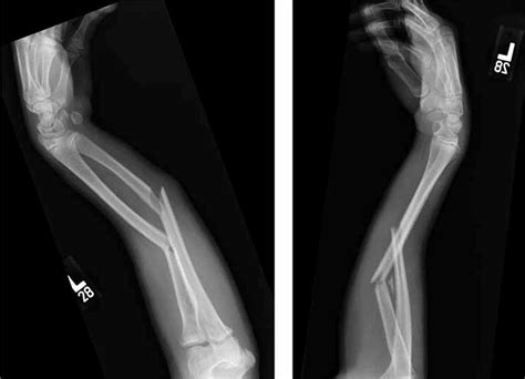 FRACTURE BOTH BONES OF THE FOREARM - Tips Health 24 Hours