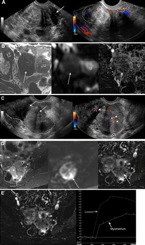 Adnexal Lesion Imaging Past Present And Future Radiology