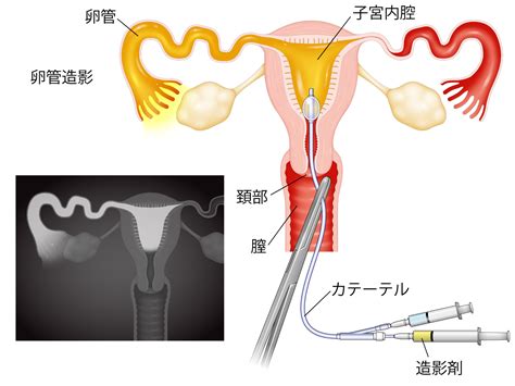 不妊治療検査 ｜ みたき総合病院 産婦人科〈三重県四日市市〉