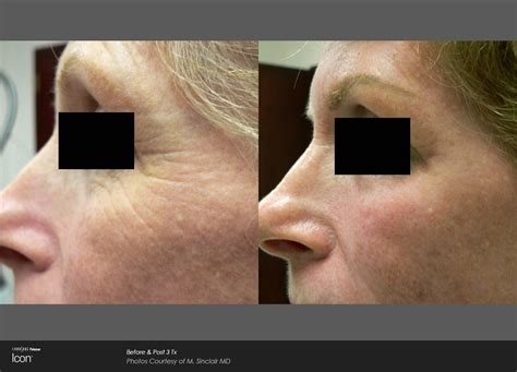 Fractional Laser Resurfacing Rockville Md Olsen Aesthetics