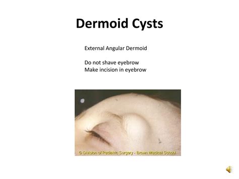 Dermoid And Epidermoid Cysts Ppt