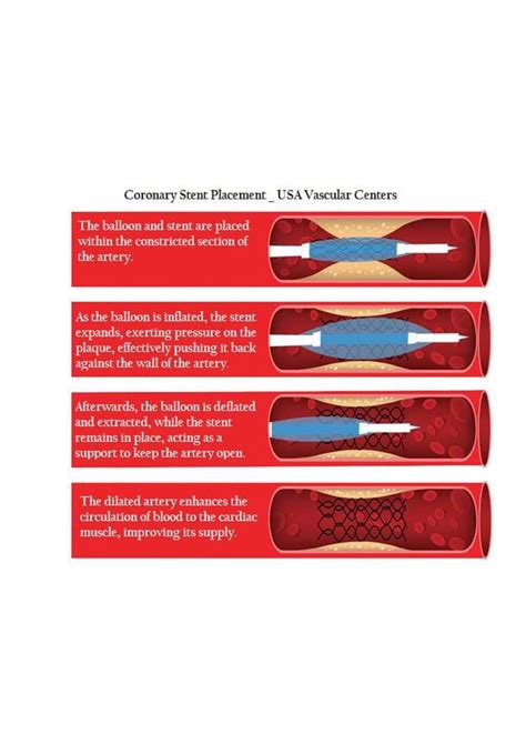 What is an Angioplasty Procedure | USA Vascular Centers | PDF