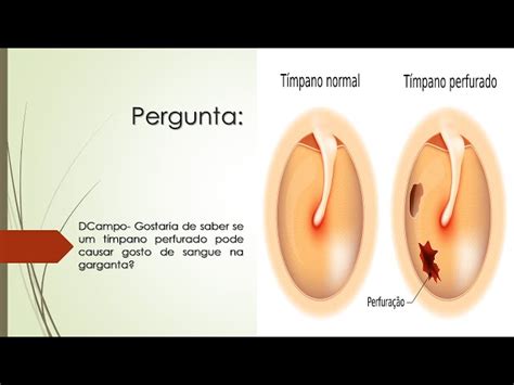 Como Saber Se Estourou O Timpano - Timpano Perfurado Você Já Ouviu Falar Em Tímpano Perfurado?