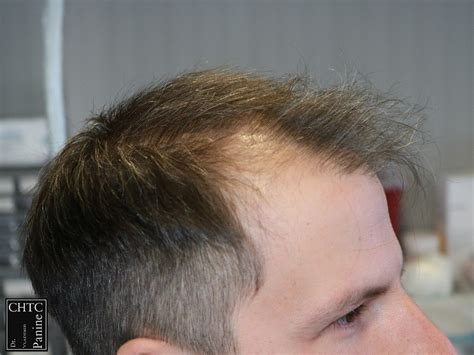 Panine Md Chicago Hair Transplant Clinic Results Of Fue Hair Transplant With 2 500 Grafts