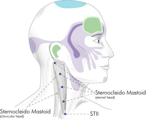 Sternocleidomastoid Insertion Trigger Point Region Download