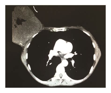 Chest Tomography At The Admission Download Scientific Diagram