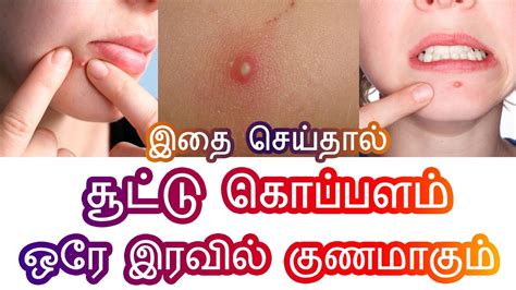 Heat Boils Tips In Tamil சூட்டு கொப்பளம் குணமாக Sootu Kopalam Tips