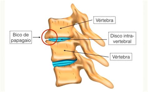 O Guia Completo Sobre Bico De Papagaio Osteofitose