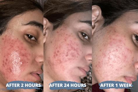 Microneedling Before And After Pro Needling