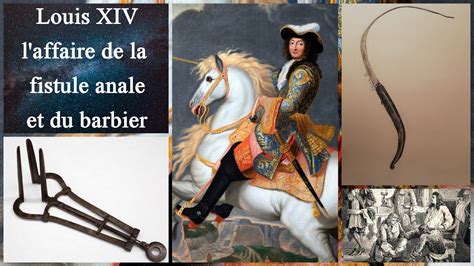 Louis XIV L Affaire De La Fistule Et Du Barbier YouTube