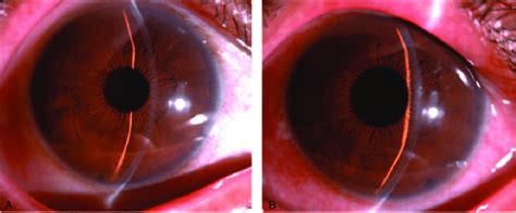 Slit Lamp Photographs Of The Patient On Presentation A Slit Lamp Download Scientific Diagram