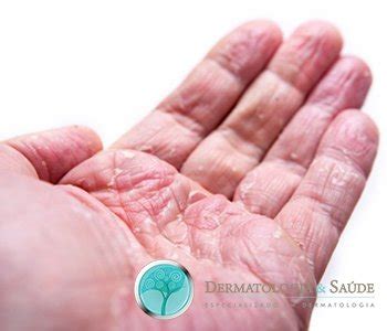 Alergia Na Palma Da Mão E Nos Pés - Arquivos Dermatite das mãos e pés - Dermatologia e Saude