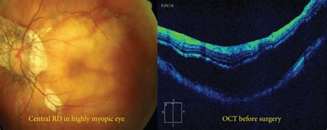 (a) Fundus photograph of a highly myopic eye with central macular ...