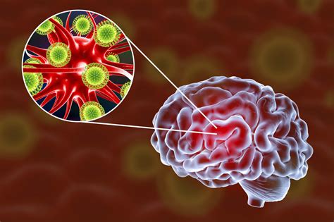 Encefalitis QUÉ ES LA ENCEFALITIS EQUINA SINTOMAS Y TRATAMIENTO