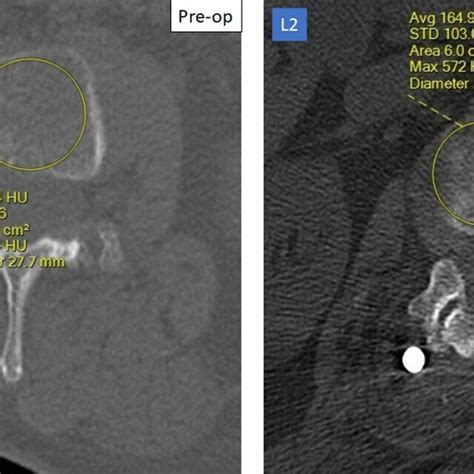 Measure Of Hounsfield Units Off Of A Lumbar Computed Tomography Scan At L1 Download Scientific