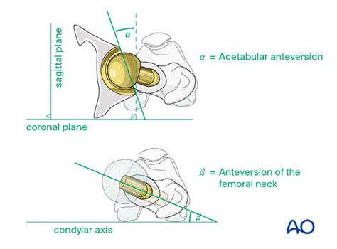 Total Hip Arthroplasty For Displaced Subcapital Femoral Neck Fractures