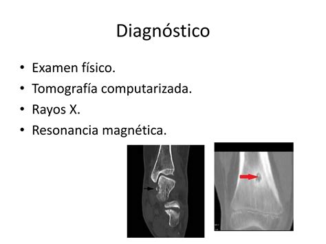 Osteoma Osteoide Pptx