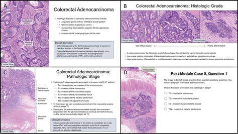 Adenocarcinoma Colon Histology