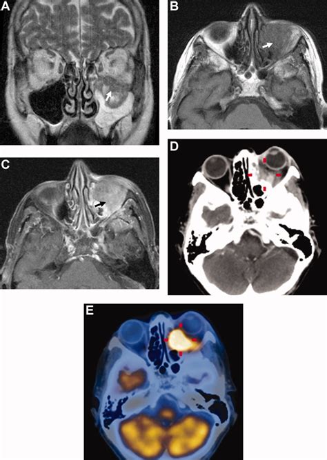 Double Density Sign In Fungal Sinusitis Filled With Allergic Mucin