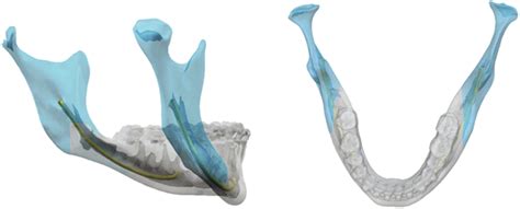 Defining The Safe Zone For The Low Medial Horizontal Cut In The