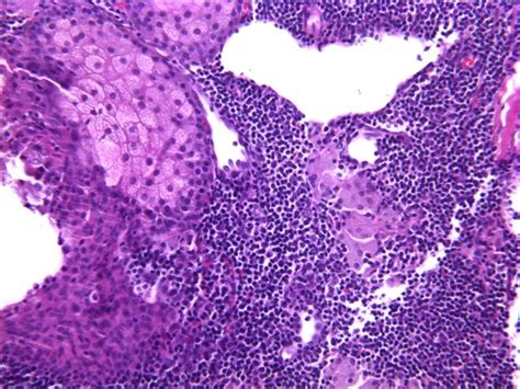 Pathology Outlines Lymphadenoma