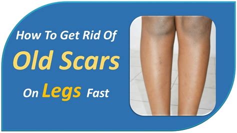 How To Get Rid Of Old Scars On Legs Fast Withe Vitamin Oil Lemon