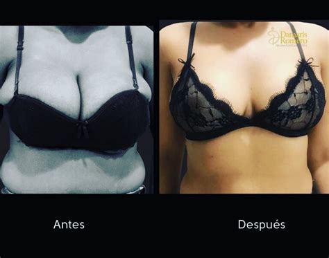 Mamoplastia Redutora Antes E Depois