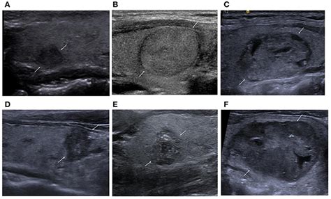 Frontiers Comparison Of Different Risk Stratification Systems For The Diagnosis Of Benign And