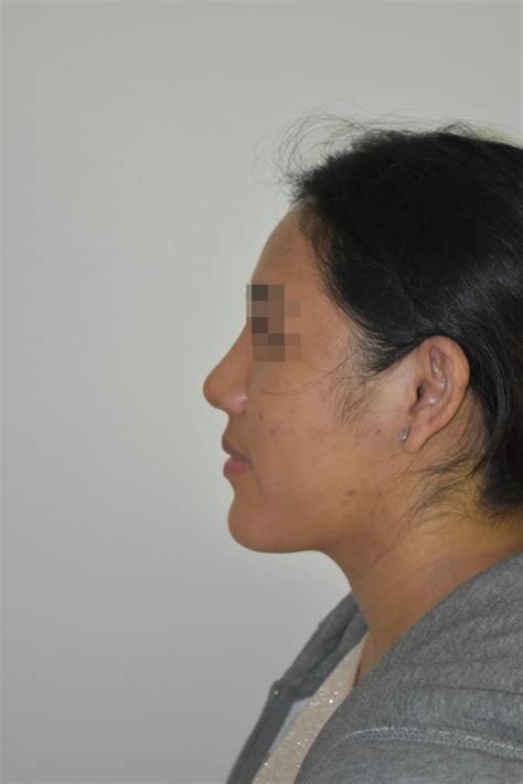 Rhinoplastie Conservatrice ultrasonique avant après