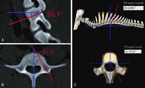 Pre Operative Planning Of Screw Trajectory A A Planned Tilt Angle Of