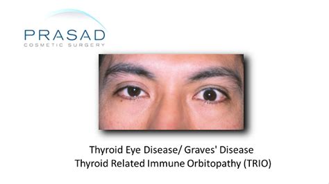 Thyroid Eye Disease Graves Disease Dr Prasad Ny