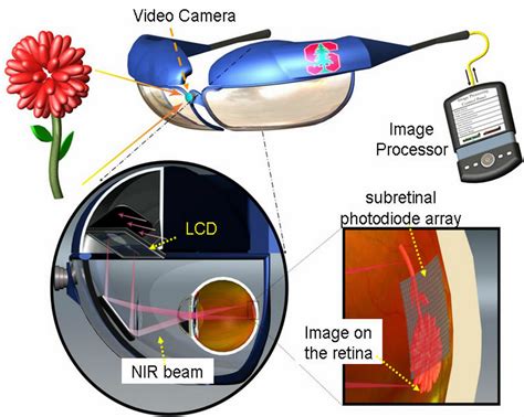 New Type Of Retinal Prosthesis Could Restore Sight To Blind Kurzweil