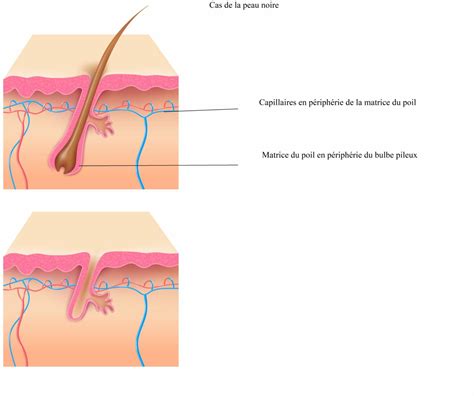 10 questions sur l épilation laser Clinique Rivoli Massena Strasbourg