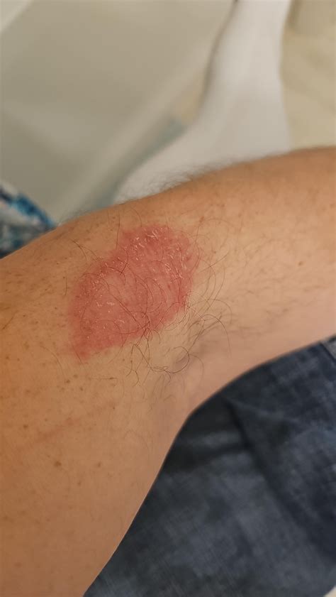 Rash On Inner Elbow R Dermatologyquestions