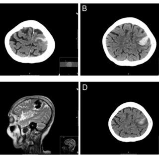 Boston criteria for cerebral amyloid angiopathy diagnosis. | Download ...