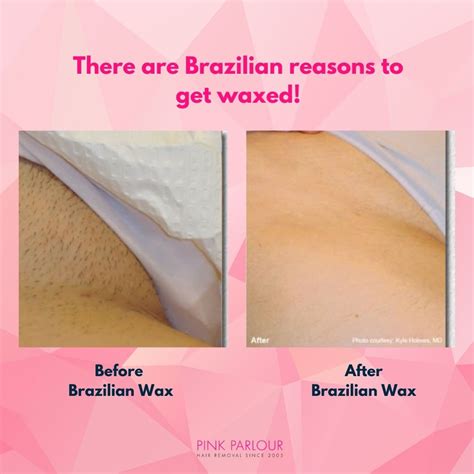 Brazilian Wax Before After Pictures Mendekar