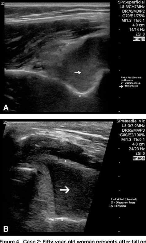 Elbow Ultrasound Anatomy