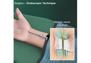 Endoscopic Carpal Tunnel Surgery Austin, TX | Carpal Tunnel Syndrome ...