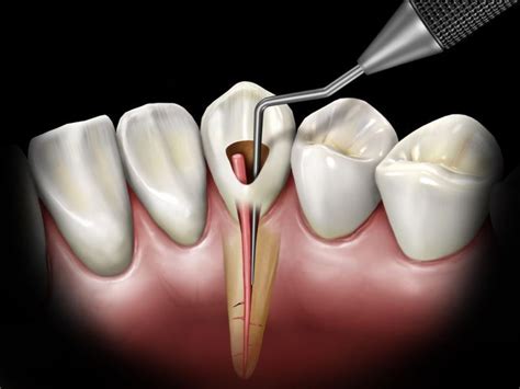 Root Canal Removal Protocol With Prf And Ozone