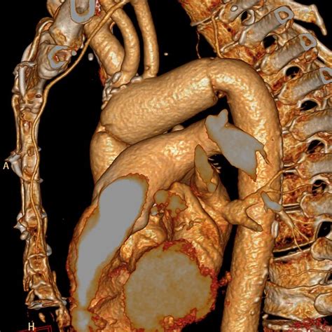 Postoperative Ct Scan Reconstruction With The Replacement Of The Arch