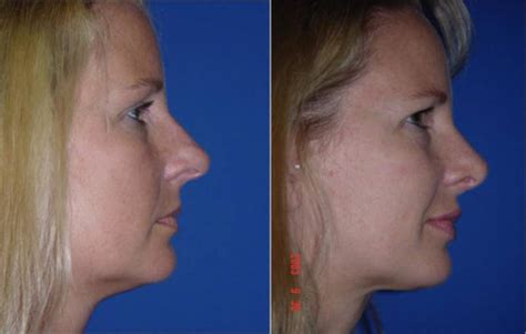 Plastic Surgery Nose Job By Dr Michael Stefan Md Miami Florida