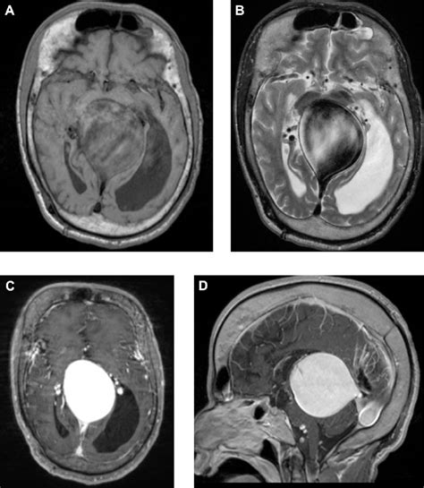 E A Axial T1W B Axial T2W C T1W Postcontrast And D Sagittal