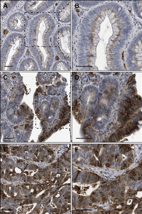 Glut Immunohistochemical Staining Of Colon Adenomas And Carcinomas