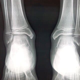 Showing bilateral feet with medial malleolus swelling | Download ...